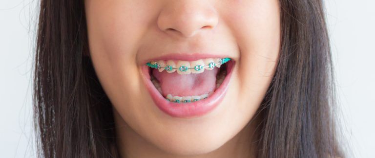 green colored braces