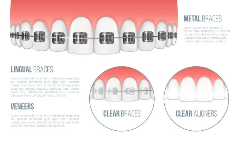 Graphic showing different types of braces